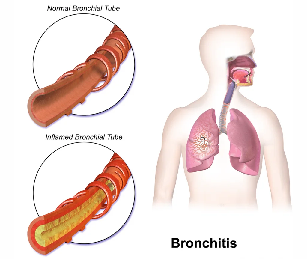 Differenza tubi bronchiali normale ed infiammati