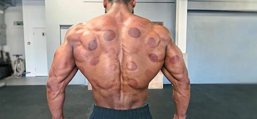 Body building with cupping signs