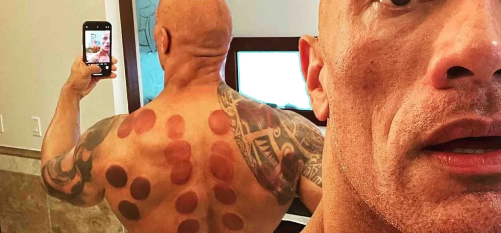 The rock cupping therapy