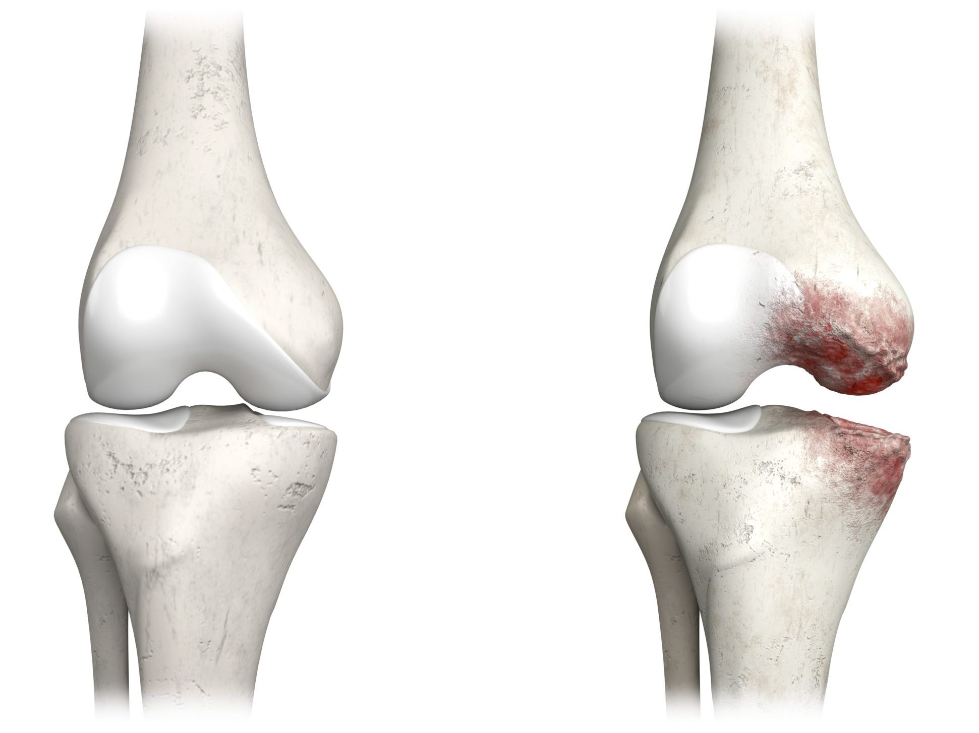 Osteoartrite al ginocchio