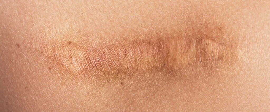 Cicatrice sulla pelle