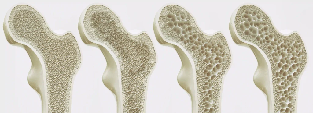 Stadi dell'osteoporosi