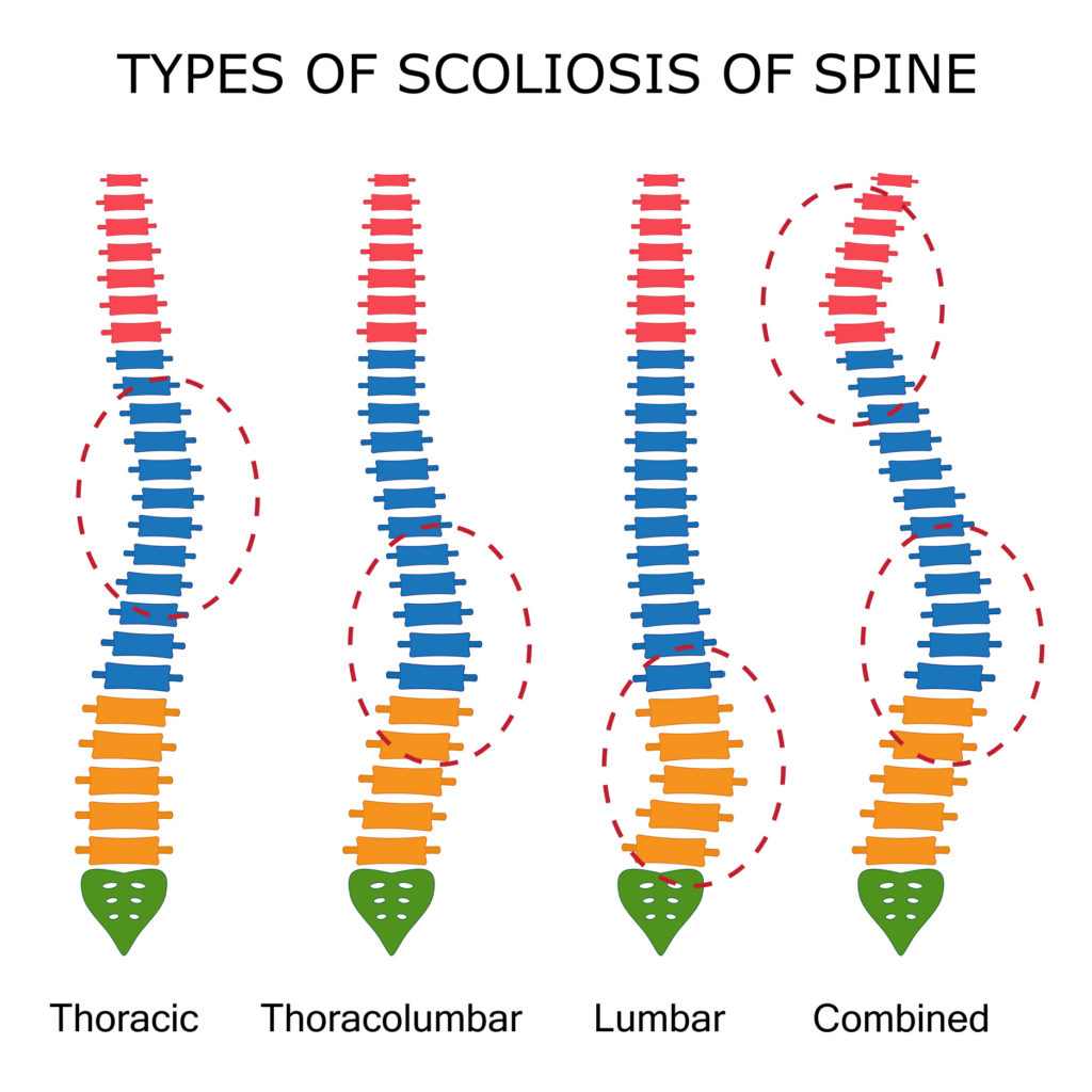 Tipologie di Scoliosi