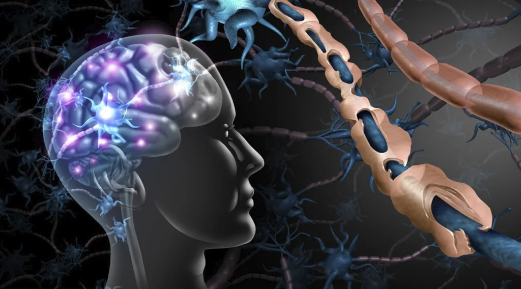Sistema nervoso centrale e neuroni con sclerosi